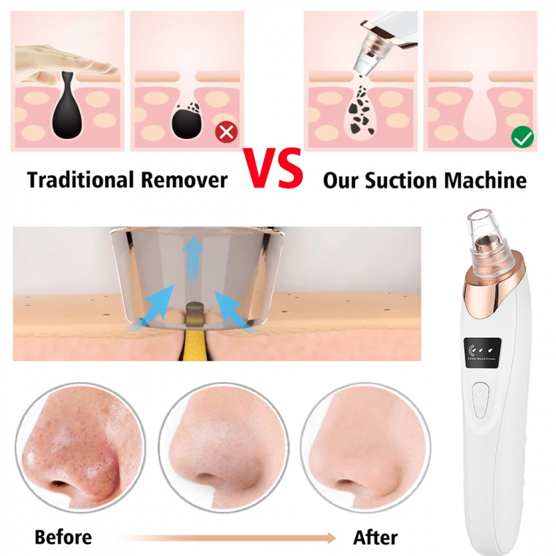 Skincare with Electric 5 in 1 Blackhead Acne Oil Remover | Shopright.pk