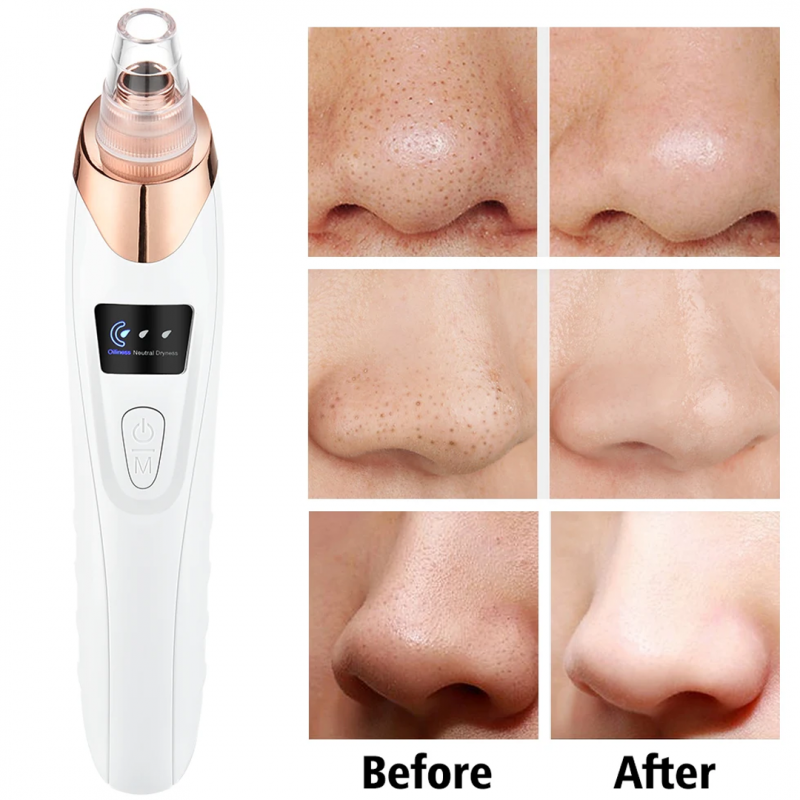 Skincare with Electric 5 in 1 Blackhead Acne Oil Remover | Shopright.pk   